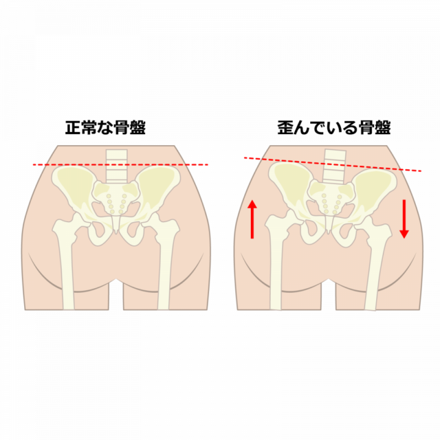 骨盤の歪み